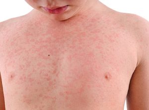 Childhood Skin Diseases Treatment in Karnal