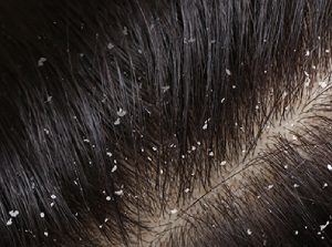 Dandruff Treatment in Karnal