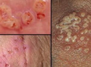 Genital And Sexually Transmitted Diseases