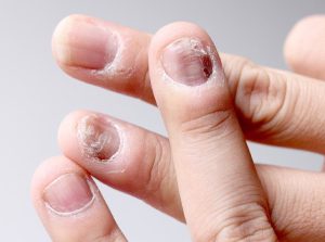 Nail Diseases Treatment in Karnal