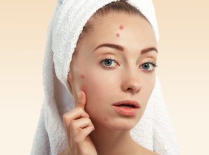 acne treatment in Karnal