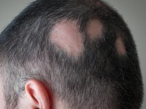 alopecia Treatment in Karnal