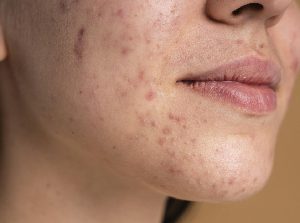 pigmentation treatment in Karnal
